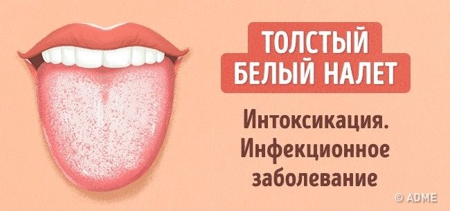 Что расскажет цвет языка о вашем здоровье