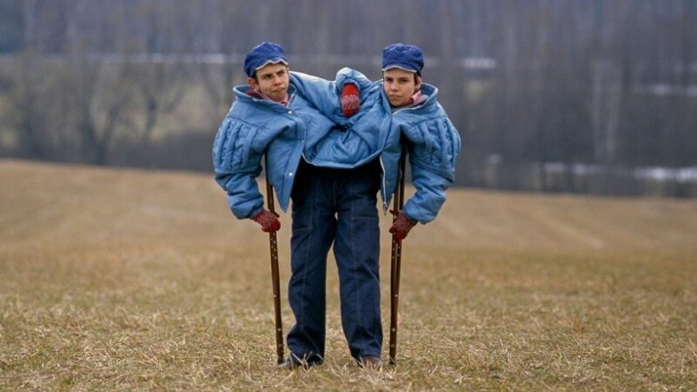 Жизнь и страдание самых известных сиамских близнецов СССР