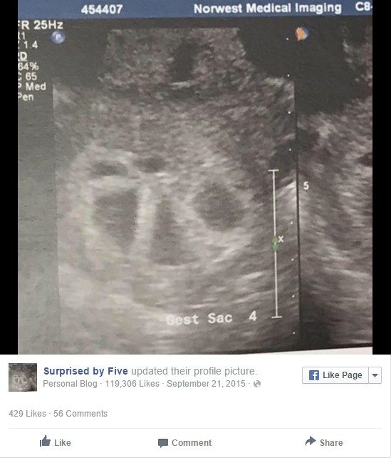 Как выглядит беременность пятерняшками