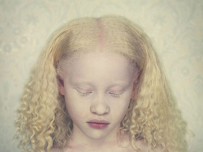 Почему появляются на свет дети-альбиносы?