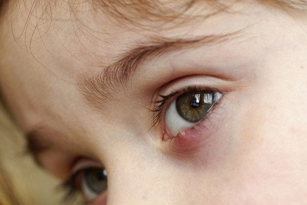 Как вылечить ячмень на глазу у ребенка?