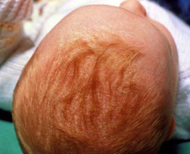 Что делать с младенческими корочками на голове у малыша?