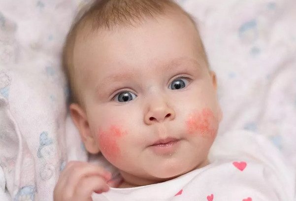 6 важных фактов про аллергию у детей