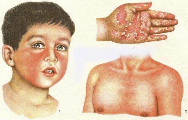 Детские болезни, опасные для взрослых