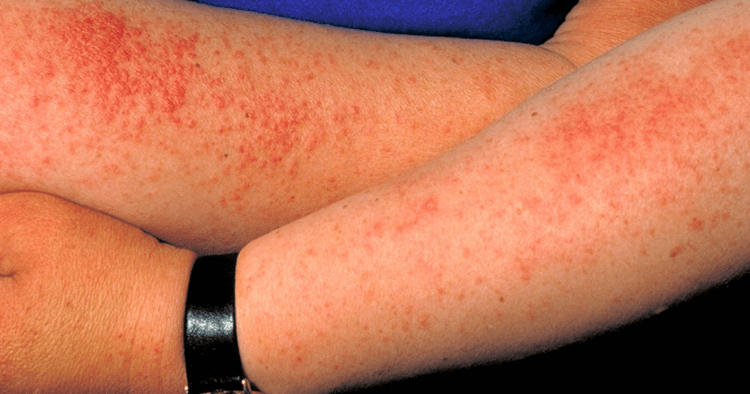 5 самых странных видов аллергии, известных медицине
