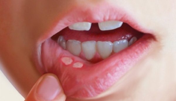 Как лечить язвочки во рту