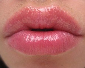 Белые точки на губах: причины, лечение