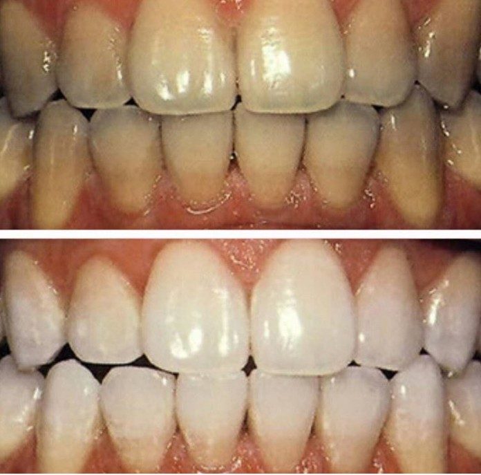Эффективные методы отбеливания зубов