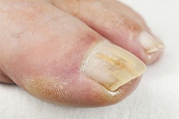 Народные методы лечения грибка ногтей