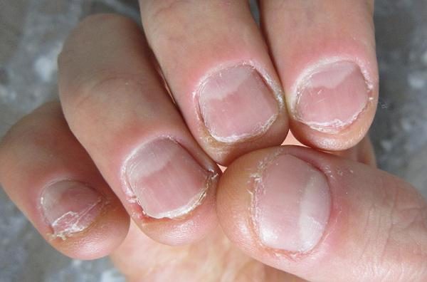 8 последствий вредной привычки грызть ногти