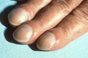 Как определить здоровье по ногтям рук