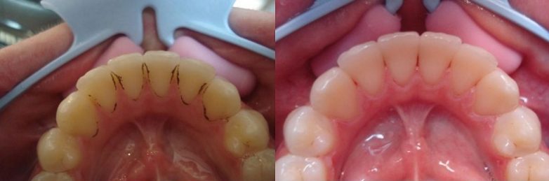 Эффективный способ отбеливания зубов