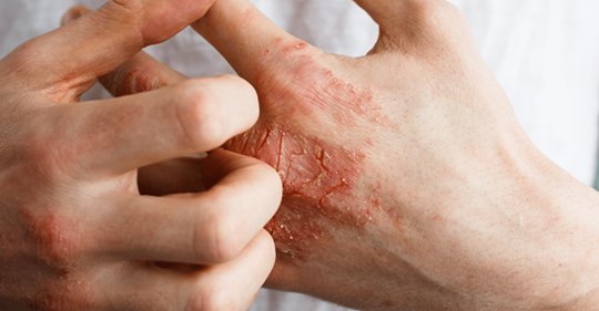 8 симптомов заболеваний, которые проявляются на ваших руках
