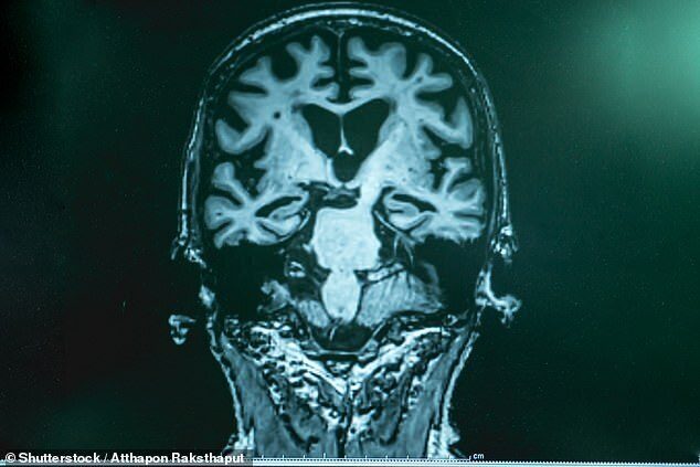 Ученые обнаружили способ лечения болезни Альцгеймера