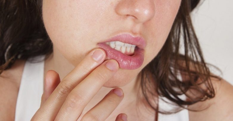 Почему образуются заеды в уголках губ