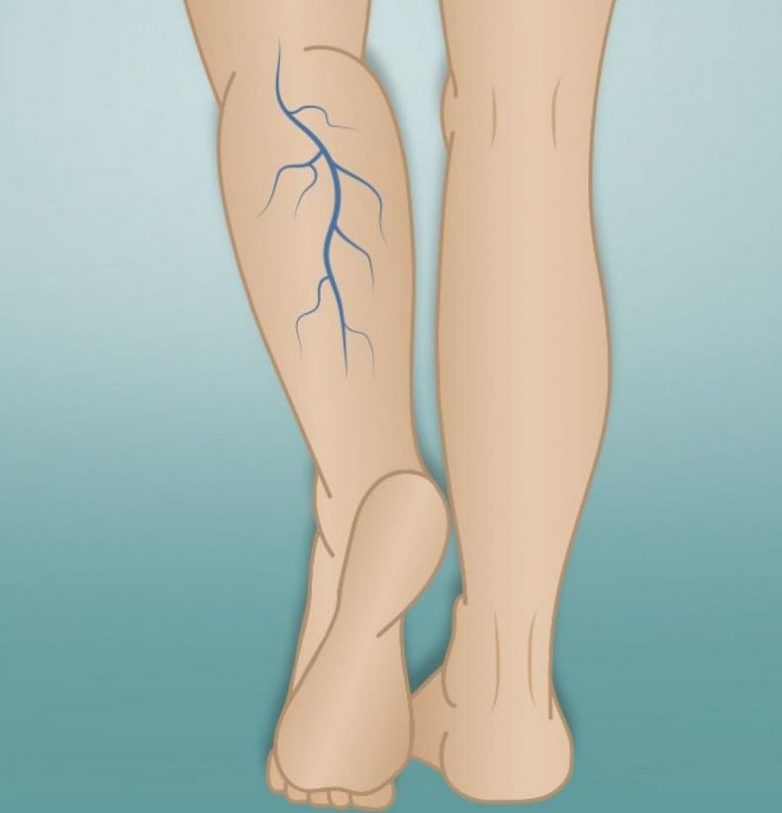 Хронические заболевания вен ног