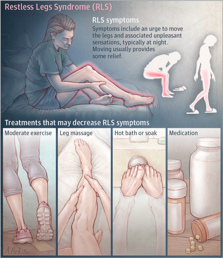 Синдром беспокойных ног: симптомы и лечение