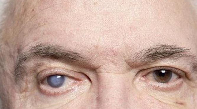 Симптомы и причины возникновения катаракты