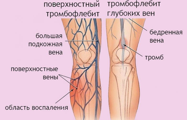 Первые симптомы тромба в ноге