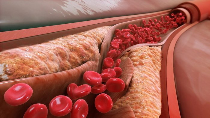 Как тромбоциты влияют на атеросклероз