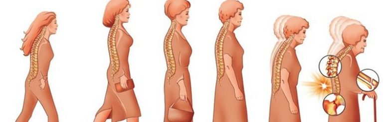 Что необходимо знать об остеопорозе женщинам 50+