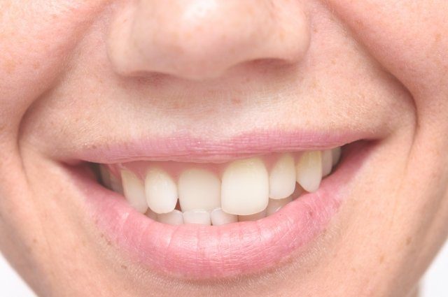 Вкривь и вкось. Какие деформации зубных рядов бывают и как их исправить?