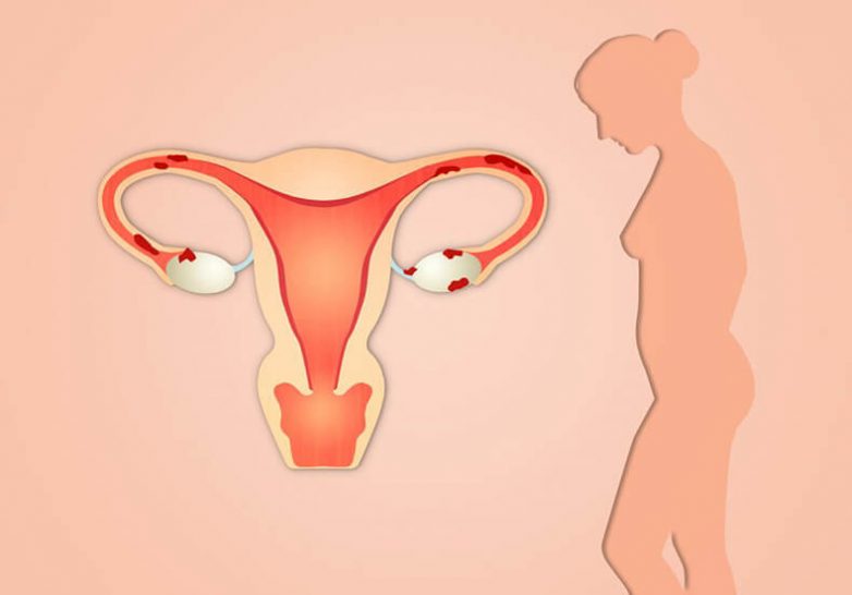 Что важно знать женщинам об эндометриозе