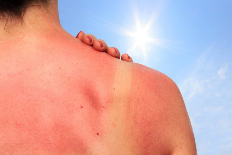 Аллергия на солнце. Как возникает и проявляется