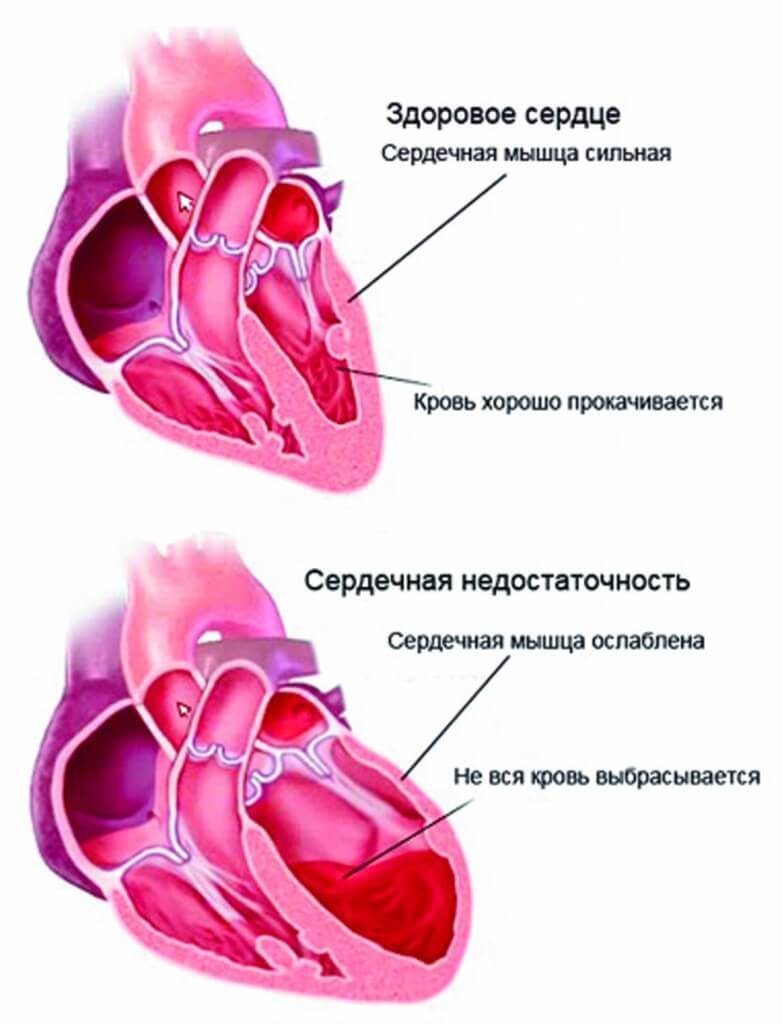 Яркие симптомы сердечной недостаточности