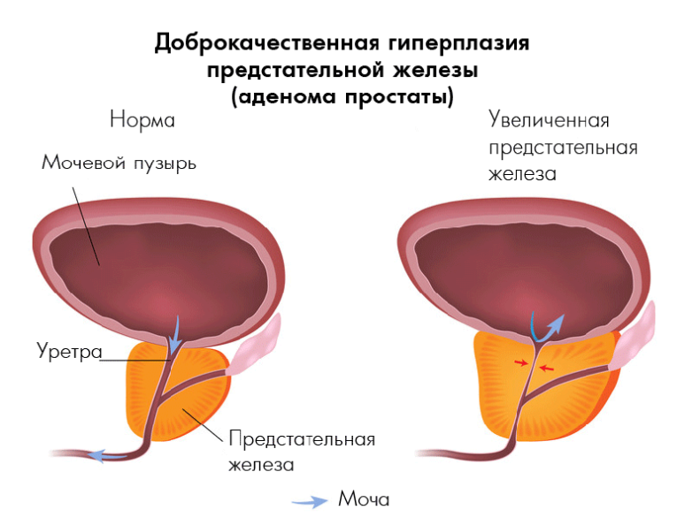 Избавляемся от простатита. Упражнения при аденоме простаты