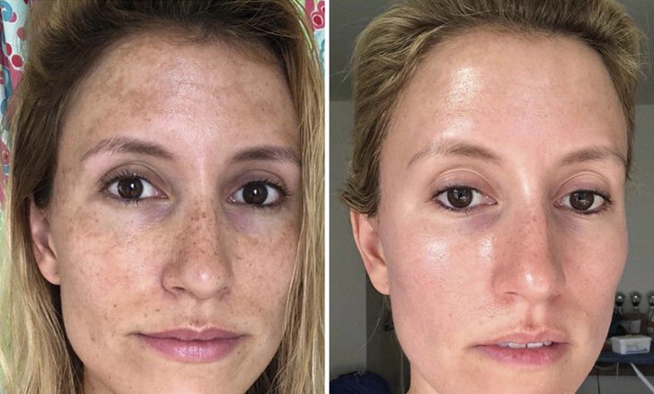 11 человек, которые добились значительных улучшений кожи лица без дорогих косметических процедур