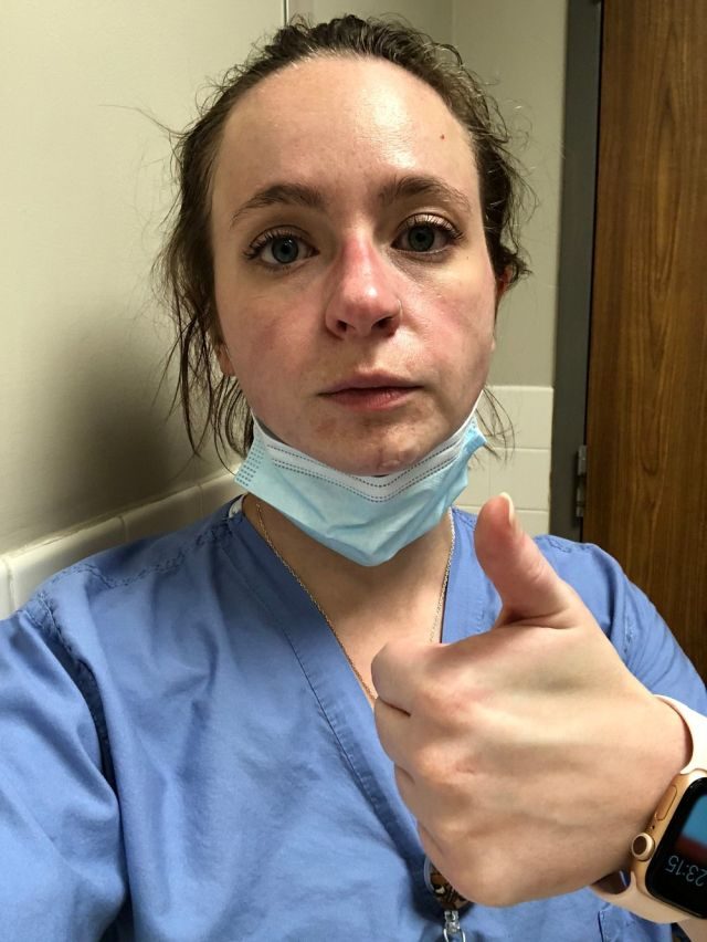 Медсестра показала, как ее лицо изменила работа в больнице за полгода пандемии коронавируса