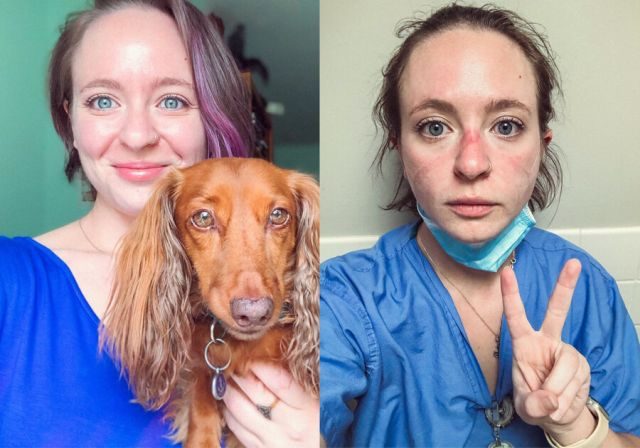 Медсестра показала, как ее лицо изменила работа в больнице за полгода пандемии коронавируса