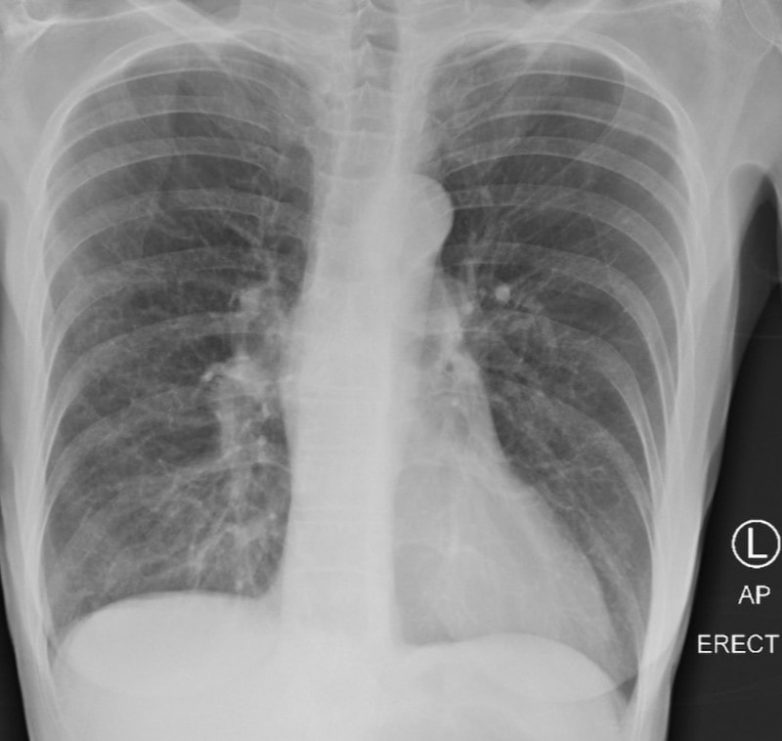 Насколько лёгкие больного COVID-19 хуже лёгких здорового человека и курильщика