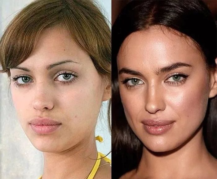 Анна Хилькевич до и после пластики - фото до и после операций