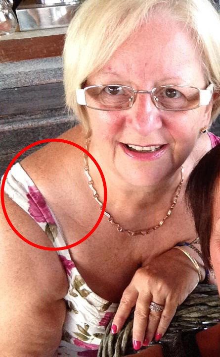 64-летняя женщина не подозревала, что происходит с ее плечом